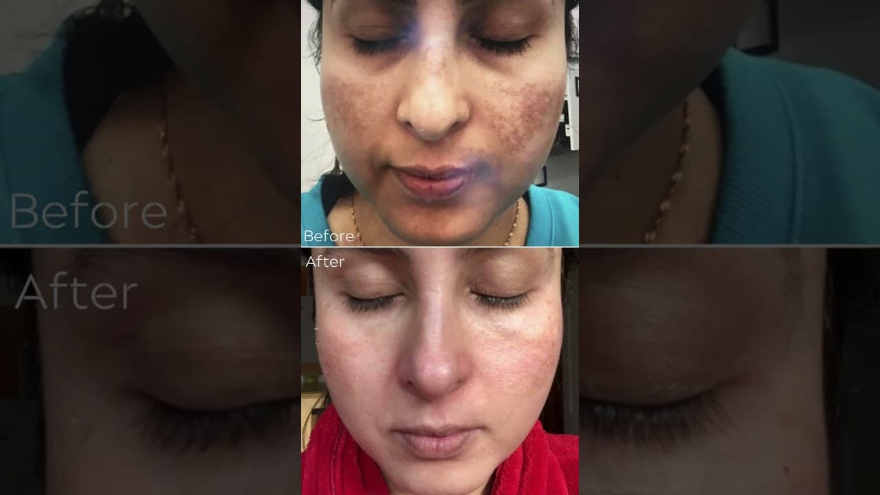Cosmelan Peel for Pigmentation | Before & After, Cost, Side Effects, Real Results Explained! — video thumbnail